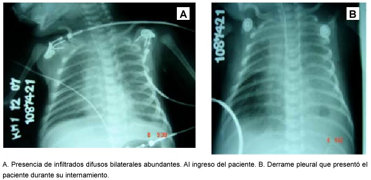 Sindrome Dificultad Respiratoria Neonatal Pdf