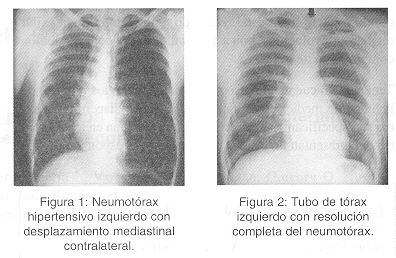 COCAÍNA OCULTA EN INHALADOR MÉDICO 