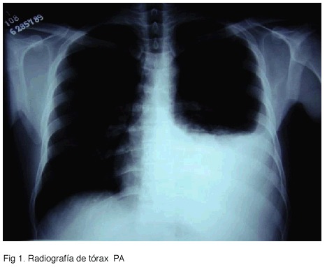 ¿Qué es la Tuberculosis pleural?