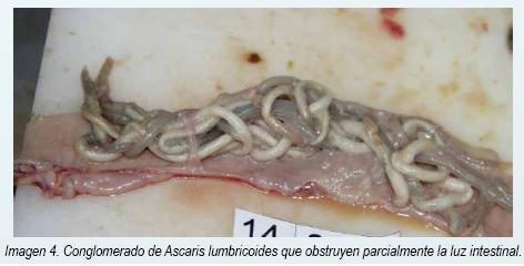 intestinal por Ascaris lumbricoides