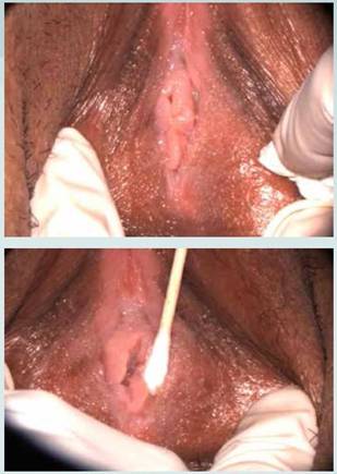 Humano labios genitales papiloma