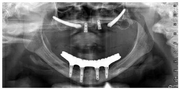 Mandíbula o prótesis dentales, dientes postizos con incisivos Vector de  Stock de ©cookamoto 331889894