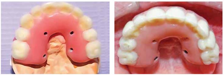 Modelo médico de la mandíbula con dientes postizos en un alfiler