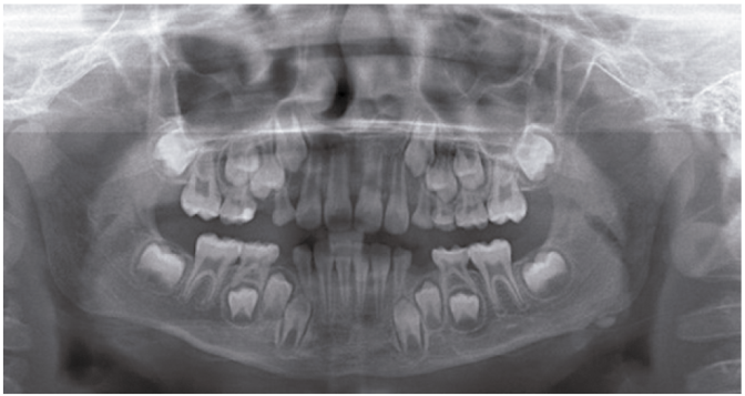 of Mandibular Angulus: of Literature and Report of a New Case