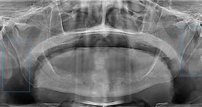 Radiografía pulmón sano y fumador